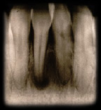 Periapical Cementaml Dysplasia UM.jpg